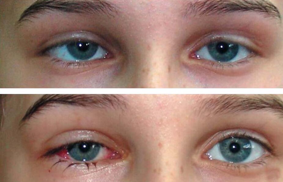 Before and after the Oculax treatment